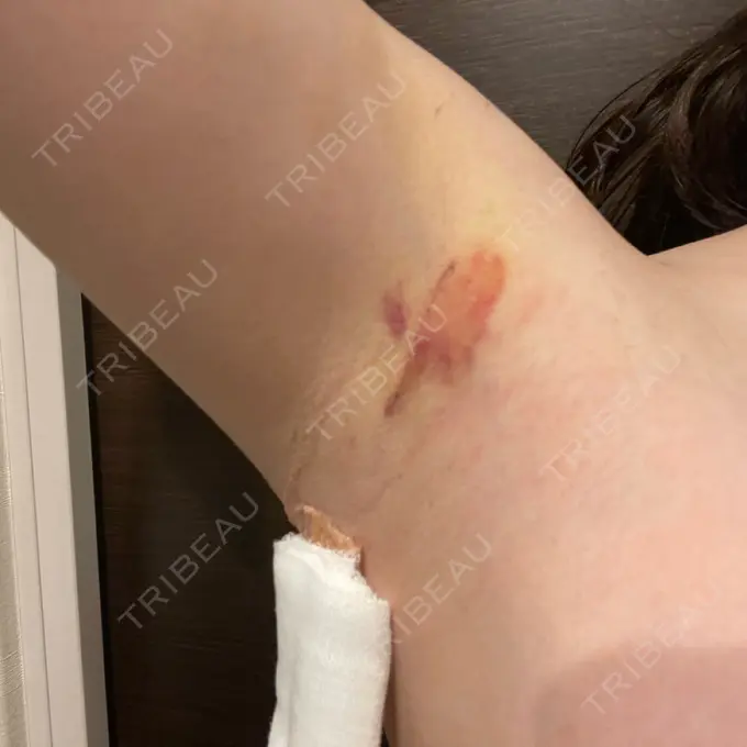 豊胸（シリコンバッグ） MYCLI【マイクリ】東京・恵比寿院 DAY 3 メイン用