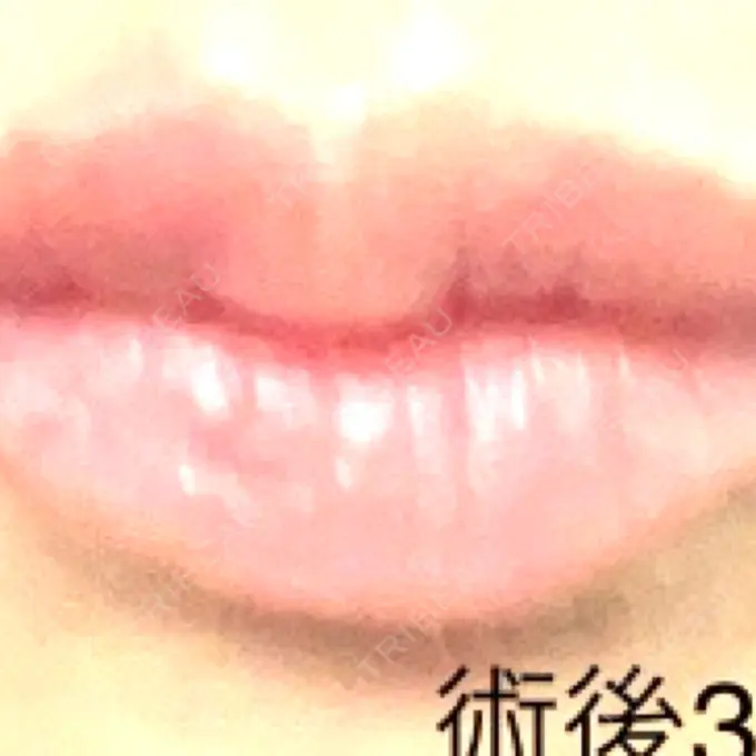 ヒアルロン酸注入（唇） 共立美容外科 大分院 AFTER メイン用