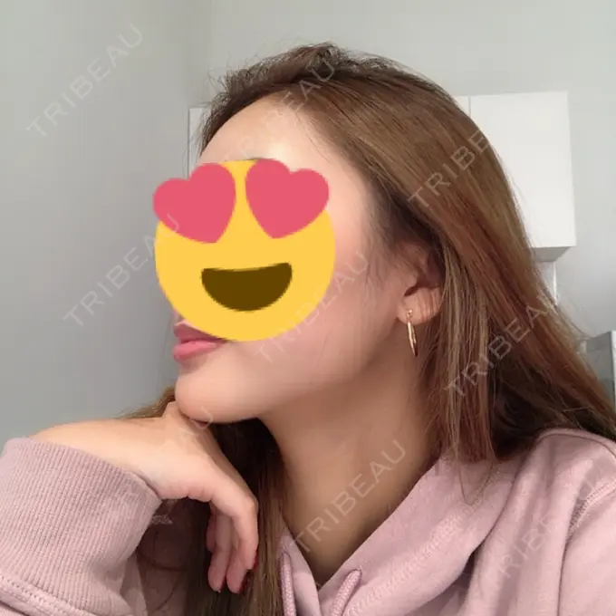 バッカルファット除去 / 脂肪吸引（顔） / 額を丸く / ヒアルロン酸注入（あご） / ボトックス（エラ・小顔） / ヒアルロン酸注入（額） エートップ美容整形外科 DAY 22 メイン用