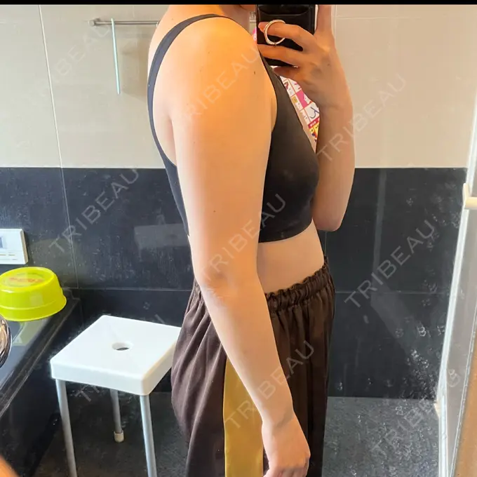 医療痩身（お腹） / 医療痩身（二の腕） 湘南美容クリニック 大阪梅田本院 AFTER メイン用