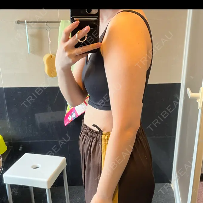 医療痩身（お腹） / 医療痩身（二の腕） 湘南美容クリニック 大阪梅田本院 DAY 18 メイン用