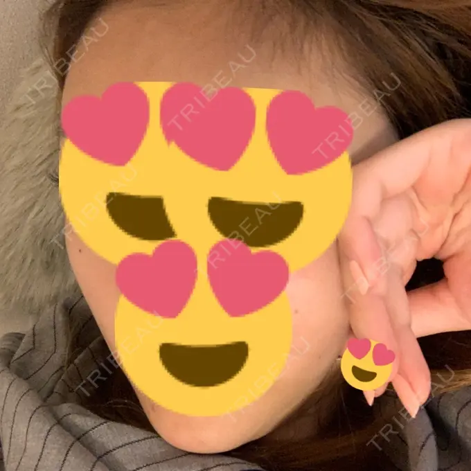 バッカルファット除去 / 脂肪吸引（顔） / 額を丸く / ヒアルロン酸注入（あご） / ボトックス（エラ・小顔） / ヒアルロン酸注入（額） エートップ美容整形外科 DAY 22 メイン用