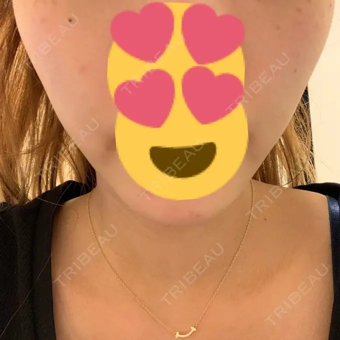 バッカルファット除去 / 脂肪吸引（顔） / 額を丸く / ヒアルロン酸注入（あご） / ボトックス（エラ・小顔） / ヒアルロン酸注入（額） エートップ美容整形外科 DAY 22 メイン用