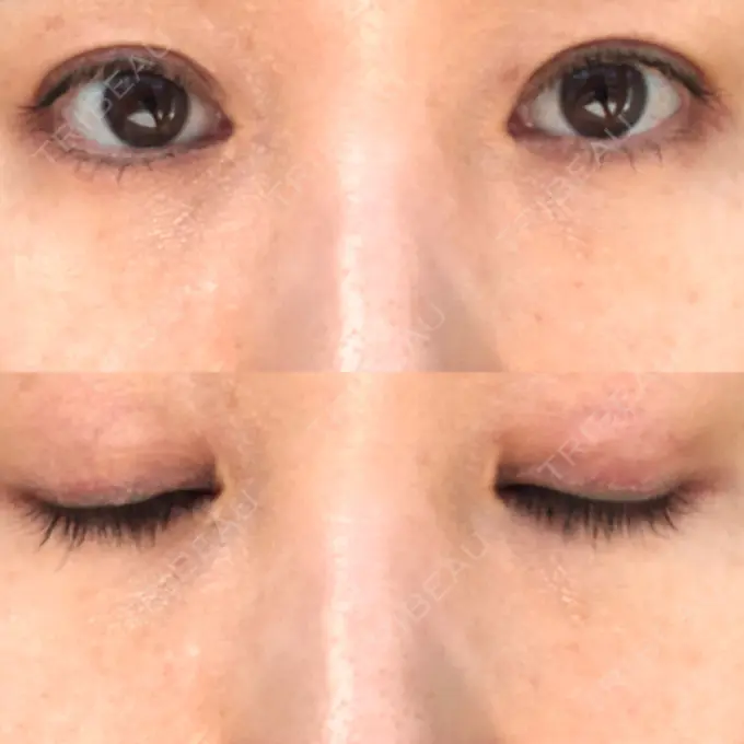 二重埋没 水の森美容クリニック 名古屋院 DAY 8 メイン用