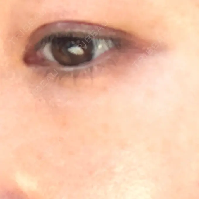 二重埋没 水の森美容クリニック 名古屋院 DAY 8 メイン用