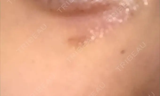 その他（肌） / 再生医療 / その他（目元） 湘南美容クリニック 大阪梅田本院 DAY 3 メイン用