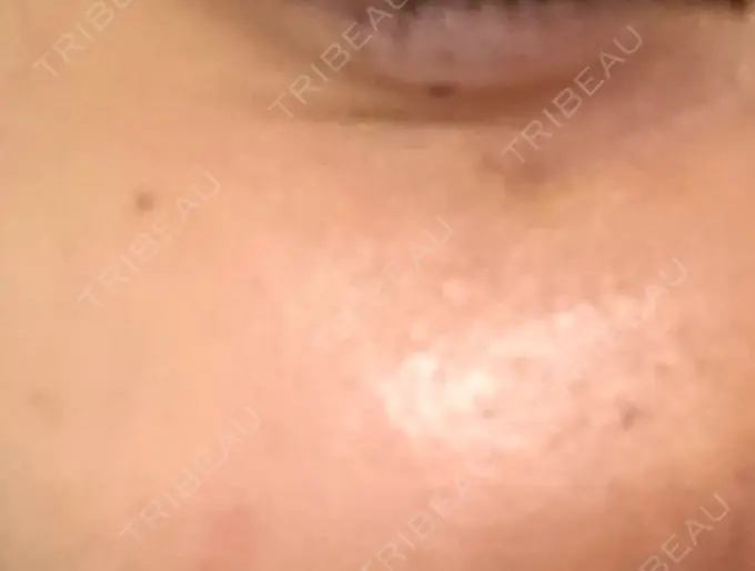 その他（肌） / 再生医療 / その他（目元） 湘南美容クリニック 大阪梅田本院 DAY 3 メイン用