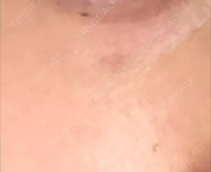 その他（肌） / 再生医療 / その他（目元） 湘南美容クリニック 大阪梅田本院 AFTER メイン用