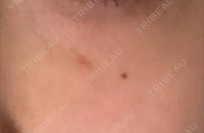 その他（肌） / 再生医療 / その他（目元） 湘南美容クリニック 大阪梅田本院 DAY 4 メイン用