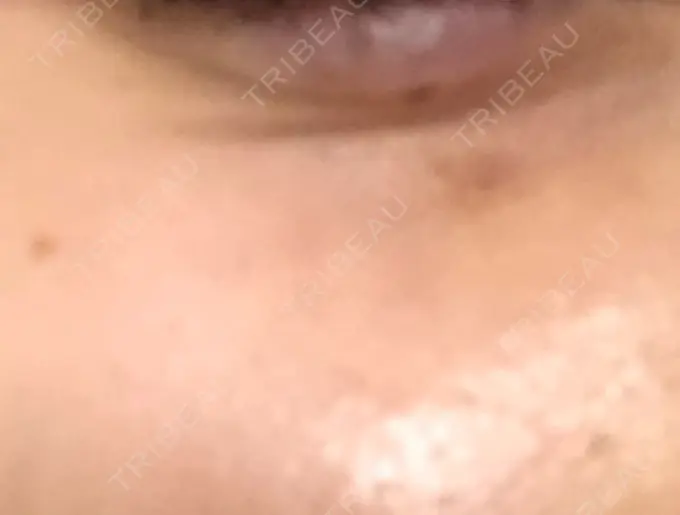 その他（肌） / 再生医療 / その他（目元） 湘南美容クリニック 大阪梅田本院 DAY 4 メイン用