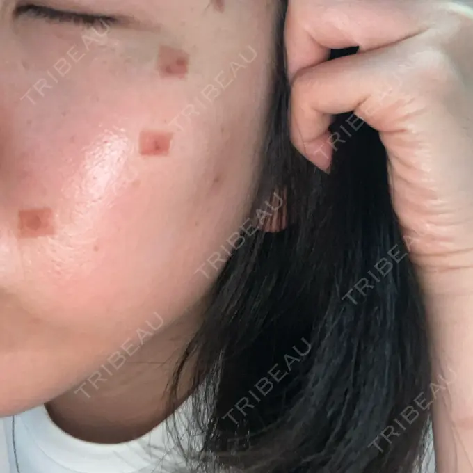 ピコスポット G MEDICAL ART クリニック 新宿院 DAY 0 メイン用