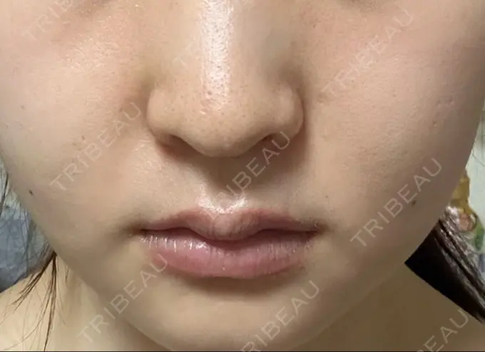 脂肪溶解注射（顔） 表参道ウィズ・クリニック AFTER メイン用