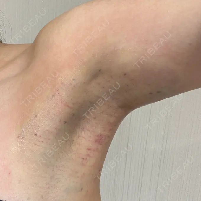 ワキ汗治療（レーザー） Fellez Clinic【フェルズクリニック】 DAY 0 メイン用