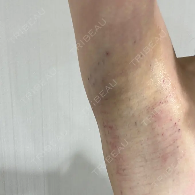 ワキ汗治療（レーザー） Fellez Clinic【フェルズクリニック】 DAY 0 メイン用