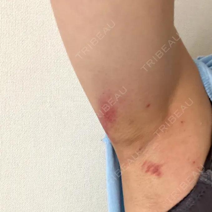 ワキ汗治療（レーザー） Fellez Clinic【フェルズクリニック】 AFTER メイン用