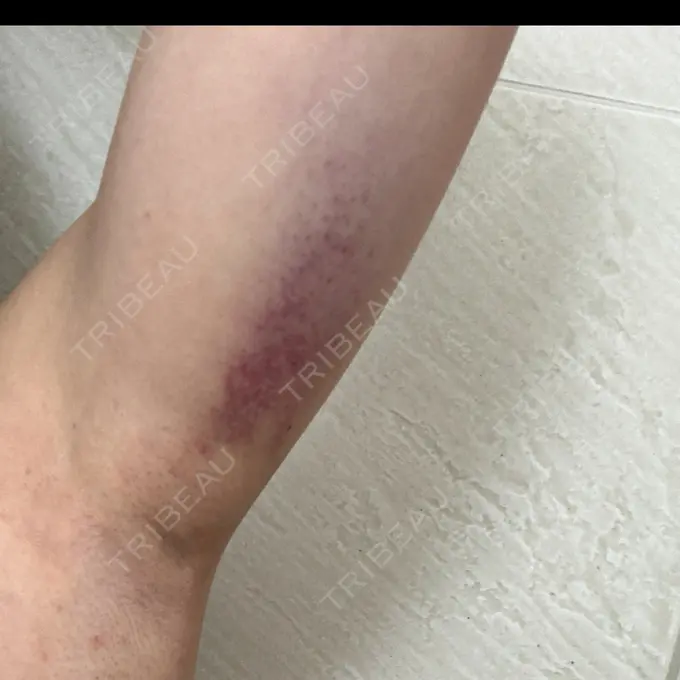 ワキ汗治療（レーザー） Fellez Clinic【フェルズクリニック】 DAY 1 メイン用