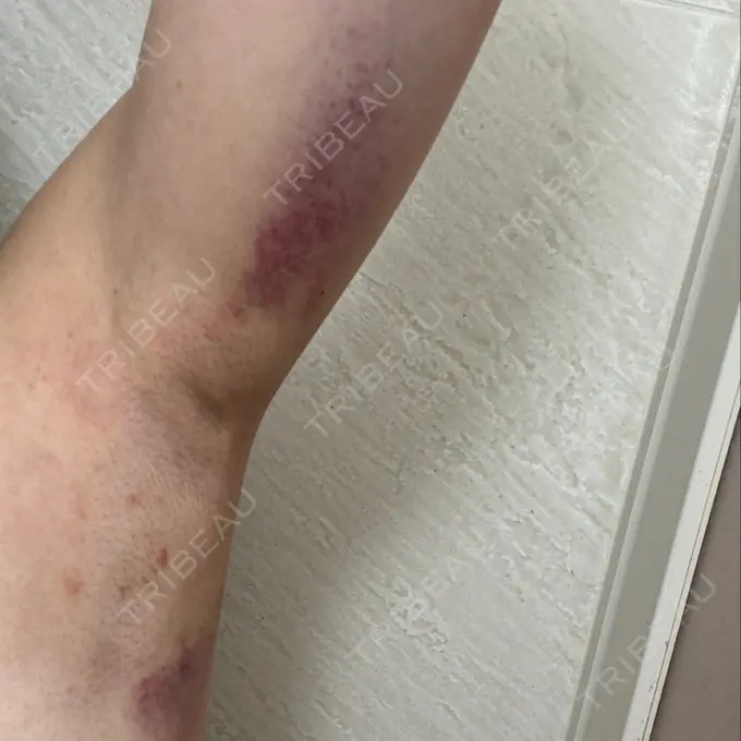 ワキ汗治療（レーザー） Fellez Clinic【フェルズクリニック】 DAY 1 メイン用