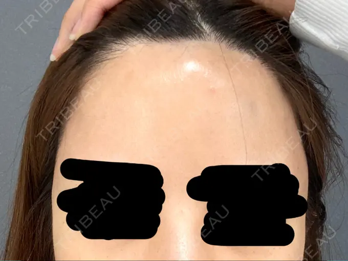 ヒアルロン酸注入（唇） / ヒアルロン酸注入（額） / ヒアルロン酸注入（こめかみ） ziz CLINIC DAY 0 メイン用