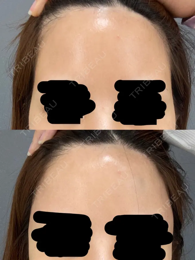 ヒアルロン酸注入（唇） / ヒアルロン酸注入（額） / ヒアルロン酸注入（こめかみ） ziz CLINIC DAY 0 メイン用