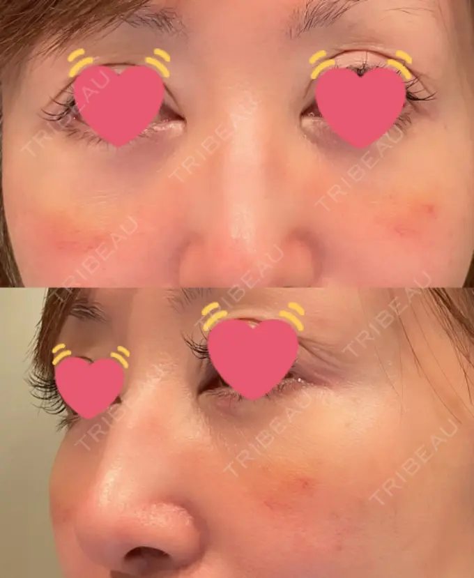 クマ治療 / 下まぶたたるみ取り / 脂肪注入（目の下） / ヒアルロン酸溶解 X CLINIC 大阪院 DAY 19 メイン用