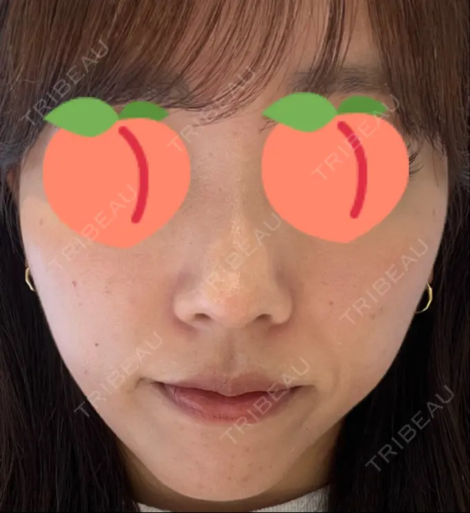 鼻尖形成（切開） / 軟骨移植 / 鼻尖縮小 / GLP-1ダイエット 東京シンデレラ美容外科 新宿院 DAY 15 メイン用