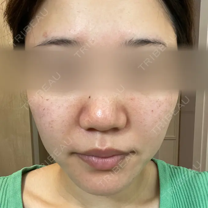 ピーリング（ニキビ・毛穴） / ルメッカ ルラ美容クリニック 名古屋本院 DAY 4 メイン用