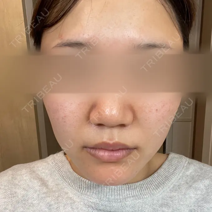 ピーリング（ニキビ・毛穴） / ルメッカ ルラ美容クリニック 名古屋本院 DAY 5 メイン用