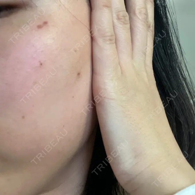 ピコスポット G MEDICAL ART クリニック 新宿院 DAY 3 メイン用