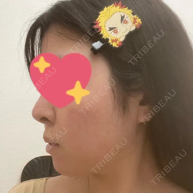 ヒアルロン酸注入（鼻翼基部） 豊洲内科・糖尿病 / 形成・美容外科クリニック AFTER メイン用