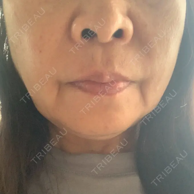 その他（肌） メディアージュクリニック 青山院 AFTER メイン用