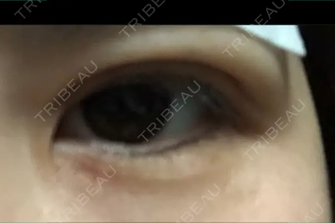 二重埋没 湘南美容クリニック 仙台院 DAY 0 メイン用