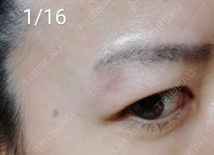 ルビーレーザー / その他（目元） Wi Clinic（ウィ クリニック） 大宮院 DAY 11 メイン用