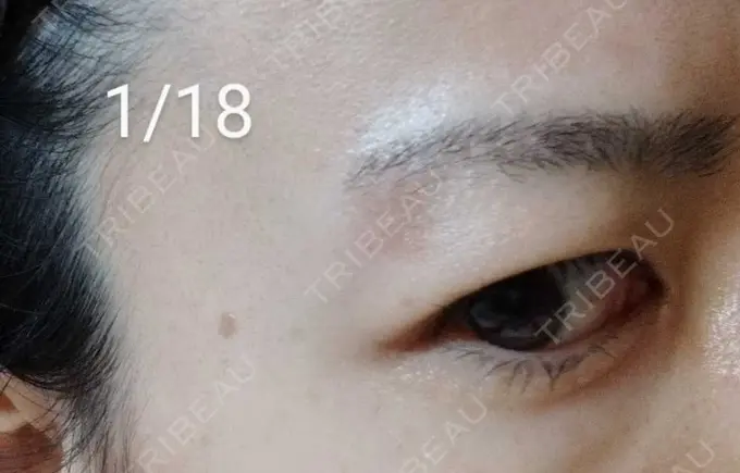 ルビーレーザー / その他（目元） Wi Clinic（ウィ クリニック） 大宮院 DAY 13 メイン用