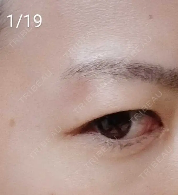 ルビーレーザー / その他（目元） Wi Clinic（ウィ クリニック） 大宮院 DAY 14 メイン用