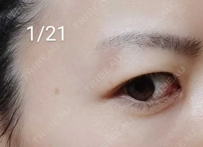 ルビーレーザー / その他（目元） Wi Clinic（ウィ クリニック） 大宮院 DAY 16 メイン用