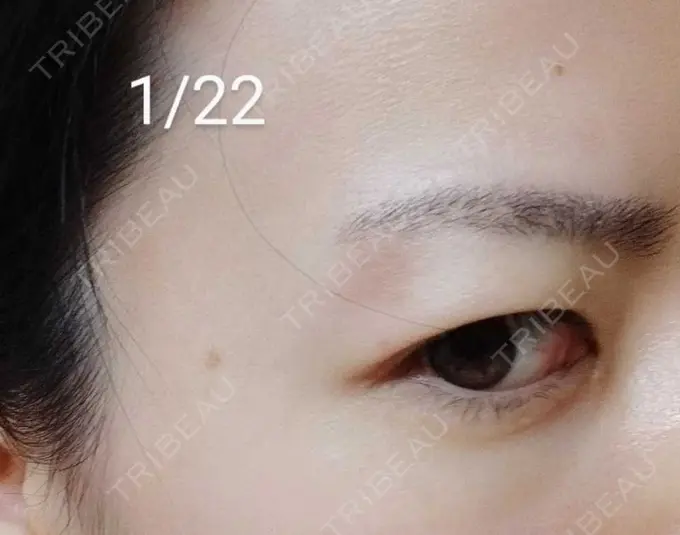 ルビーレーザー / その他（目元） Wi Clinic（ウィ クリニック） 大宮院 DAY 17 メイン用