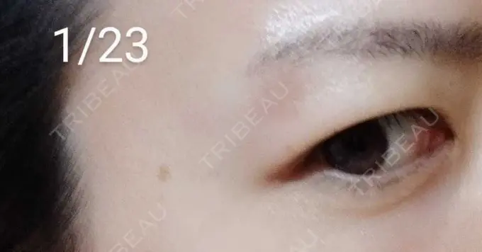 ルビーレーザー / その他（目元） Wi Clinic（ウィ クリニック） 大宮院 DAY 18 メイン用