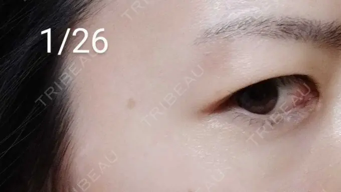 ルビーレーザー / その他（目元） Wi Clinic（ウィ クリニック） 大宮院 AFTER メイン用