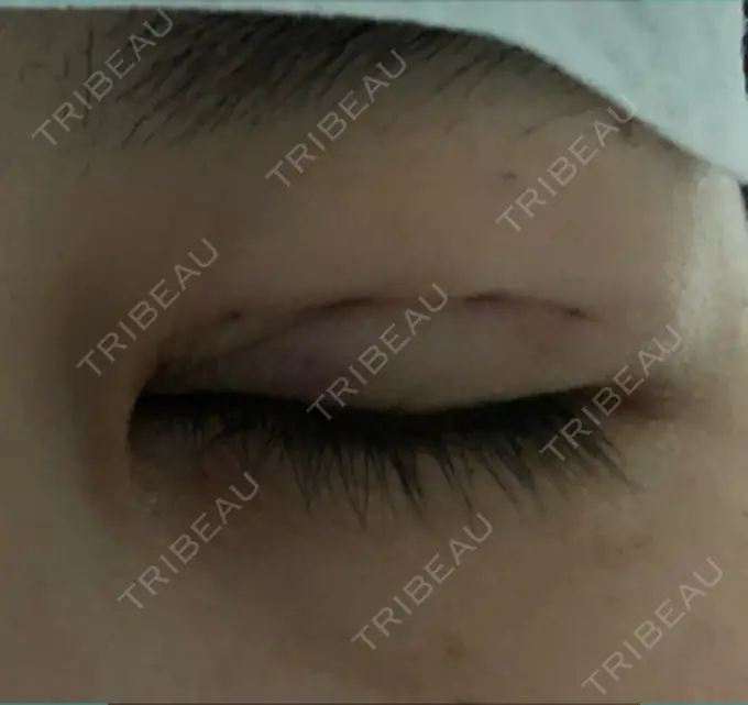 二重埋没 湘南美容クリニック 仙台院 DAY 0 メイン用