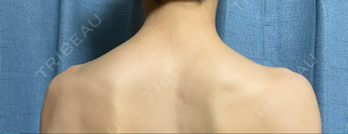 ボトックス（肩） 共立美容外科 名古屋院 DAY 3 メイン用