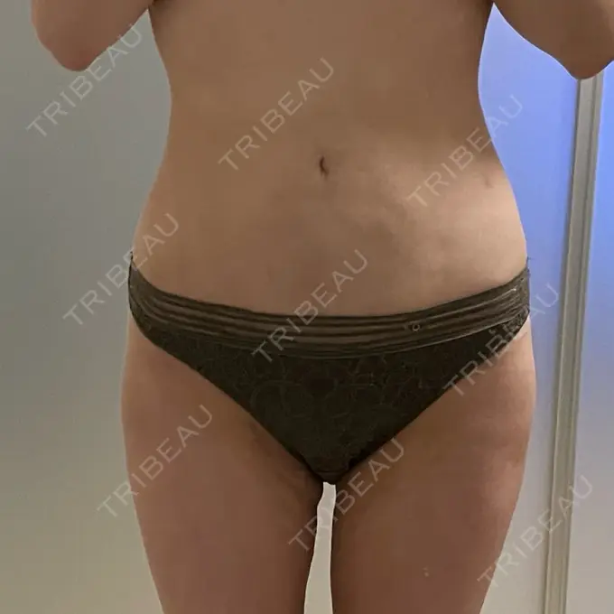 脂肪吸引（お腹） Mods Clinic（モッズクリニック） 名古屋院 AFTER メイン用
