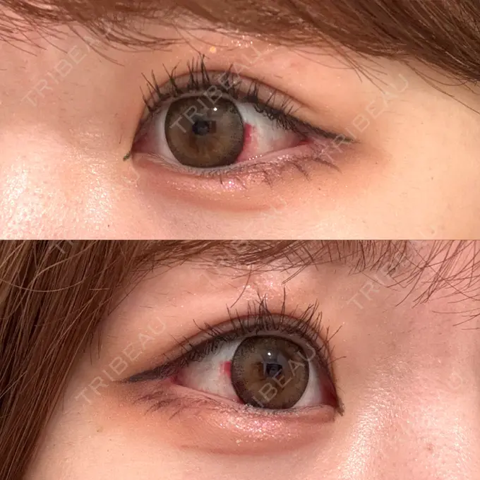 目尻切開 / 目尻靭帯移動 GLANZ CLINIC DAY 16 メイン用