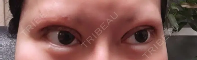 二重埋没 THE FIRST CLINIC 町田院 AFTER メイン用