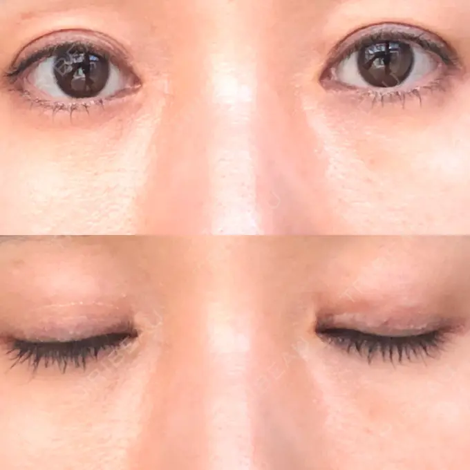 二重埋没 水の森美容クリニック 名古屋院 DAY 10 メイン用