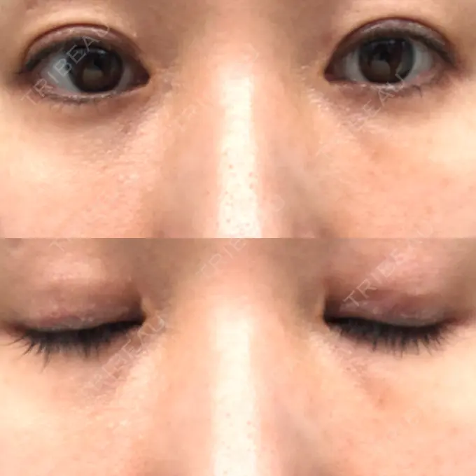 二重埋没 水の森美容クリニック 名古屋院 AFTER メイン用