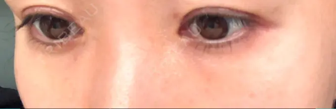 二重埋没 水の森美容クリニック 名古屋院 DAY 14 メイン用