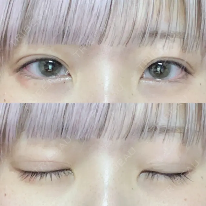 二重埋没 東京シンデレラ美容外科 池袋院 AFTER メイン用