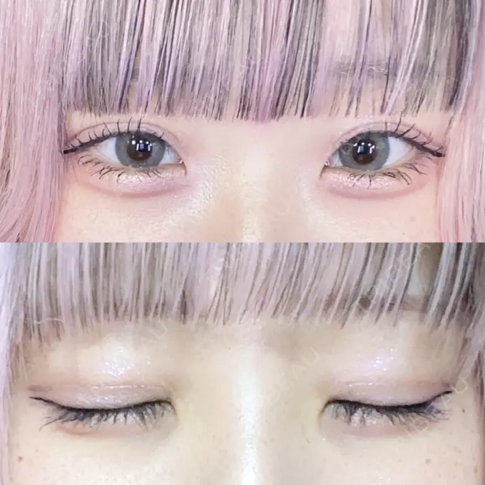 二重埋没 東京シンデレラ美容外科 池袋院 DAY 483 メイン用