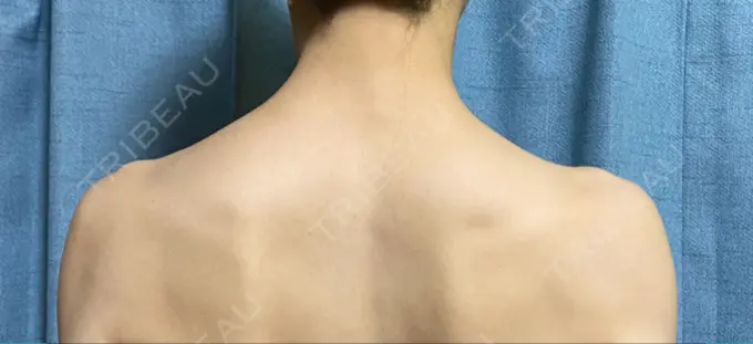 ボトックス（肩） 共立美容外科 名古屋院 DAY 7 メイン用