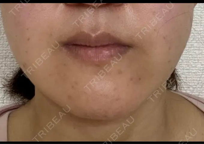 糸リフト / 脂肪吸引（顔） / 目尻切開 / 目元修正 / 輪郭修正 id（アイディ）美容外科 DAY 29 メイン用